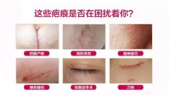 祛疤膏哪個牌子好？十款知名度最高的祛疤產(chǎn)品